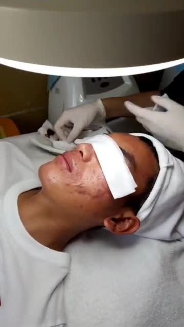 CHỚP THỜI CƠ! Trị mụn chỉ 1.000Đ  Từ 16 - 22/9