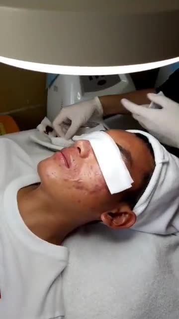 CHỚP THỜI CƠ! Trị mụn chỉ 1.000Đ  Từ 16 - 22/9