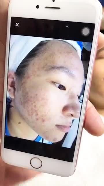 TIN ĐƯỢC KHÔNG? ĐÂY LÀ DA KHÁCH HÀNG TRỊ MỤN NANO SKIN TỚI BUỔI 6