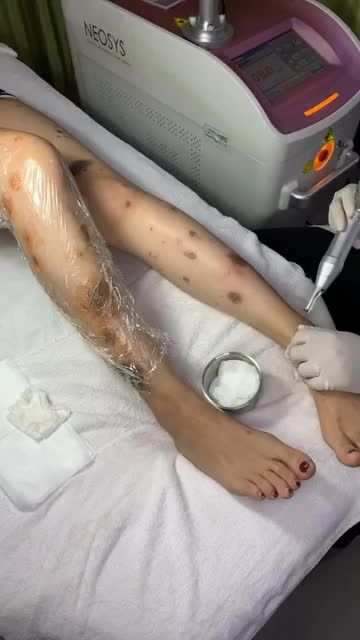 TỰ TIN DIỆN VÁY XINH SAU LIỆU TRÌNH ĐIỀU TRỊ BỚT BẨM SINH TẠI JWSKINCARE