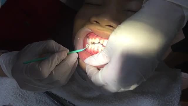 Gắn mắc cài điều trị răng thưa, đóng kín khoảng răng kẹ thừa giữa răng cửa