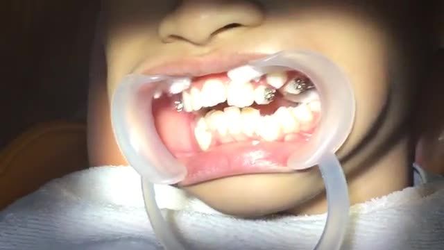 Gắn mắc cài điều trị răng VẨU, KHẤP KHỂNH