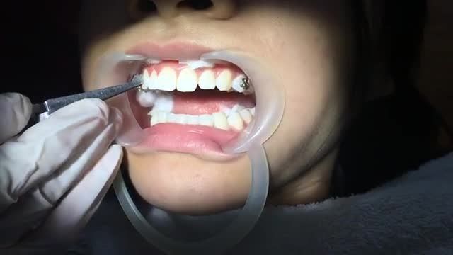 Gắn 2 ca mắc cài điều trị răng KHẤP KHỂNH lệch lạc...
