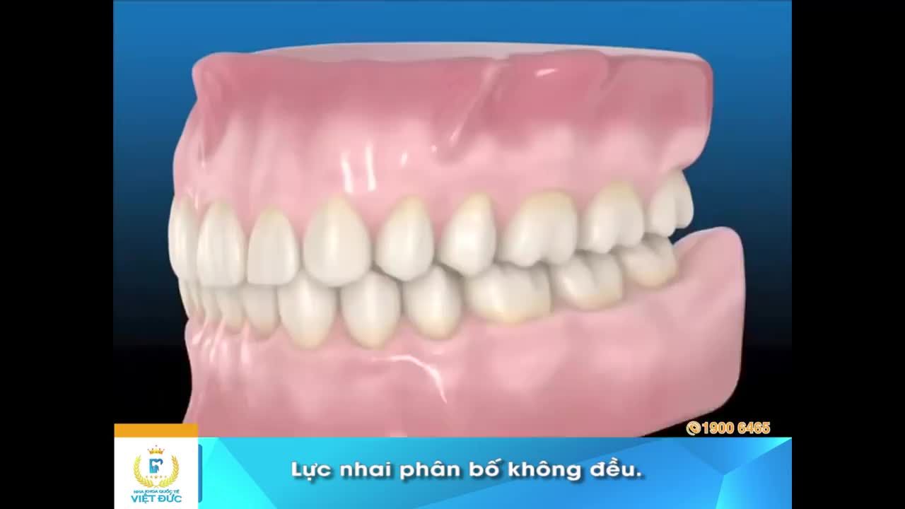NHỮNG HẬU QUẢ KHÔN LƯỜNG CỦA VIỆC MẤT RĂNG