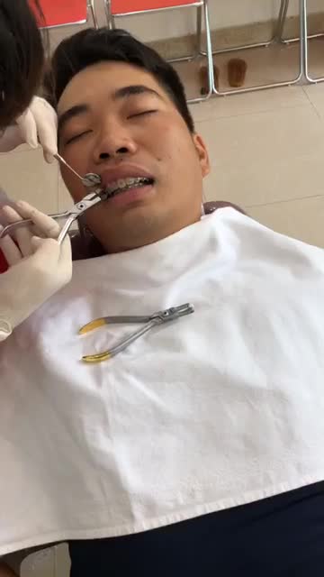 Khách hàng Lê Minh, đến từ Nam Định
Tháo niềng sau 15 tháng