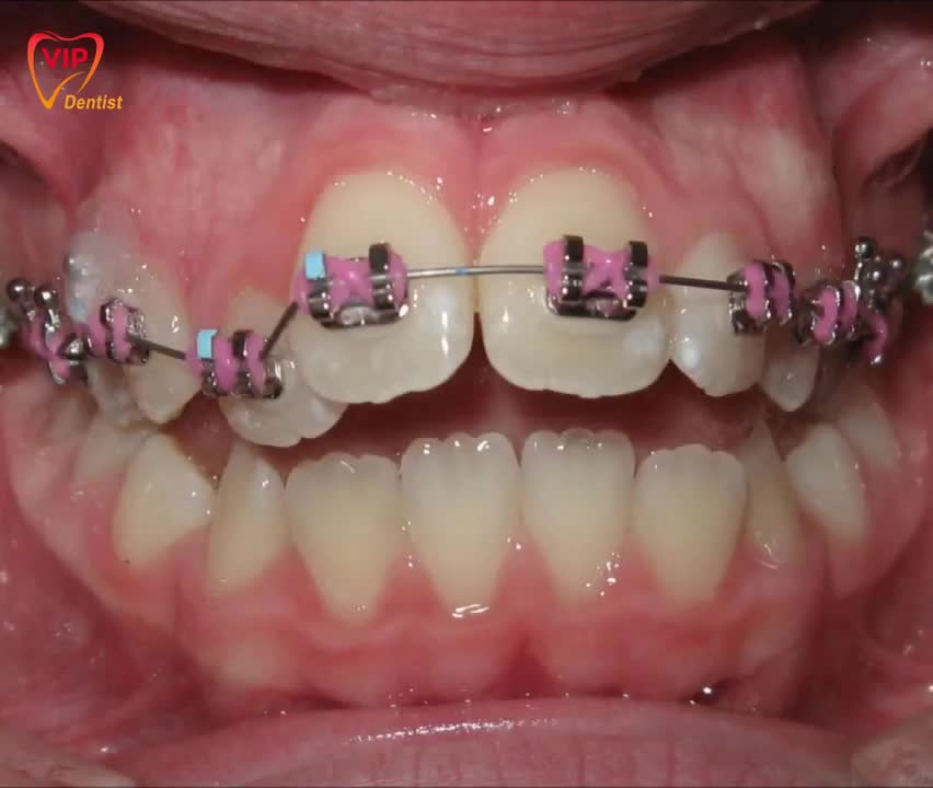 KHẮC PHỤC HOÀN TOÀN KHỚP CẮN NGƯỢC SAU 16 THÁNG
khách hàng Minh Nhi Hà Nội