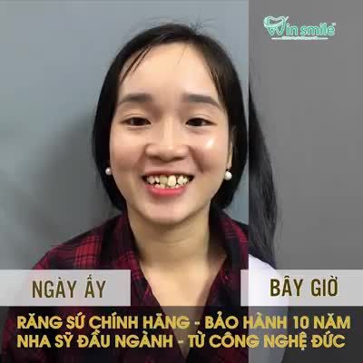 DUYÊN HƠN – CƯỜI ĐẸP HƠN SAU KHI THẨM MỸ RĂNG
