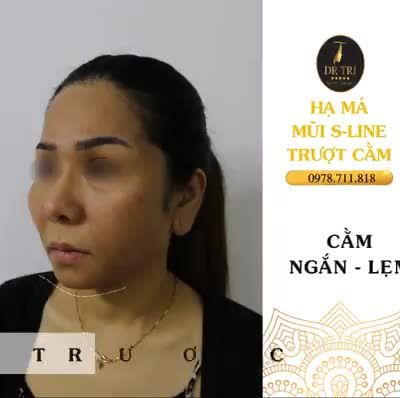 Xinh đẹp ngay sau 5 ngày phẫu thuật hạ_gò_má, nâng_mũi_S_Line và trượt_cằm