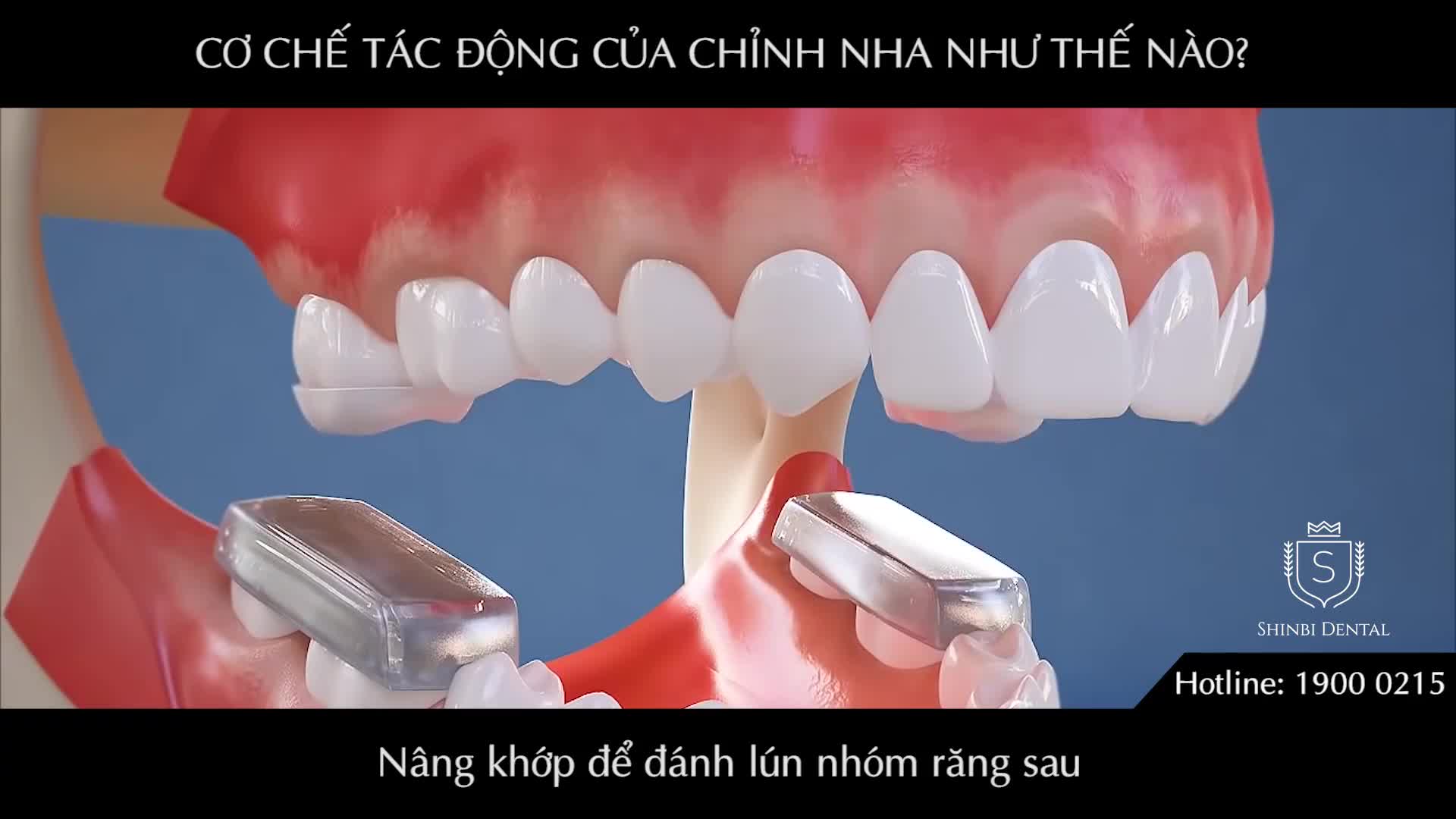 CHỈNH NHA VÀ NHỮNG ĐIỀU CẦN BIẾT