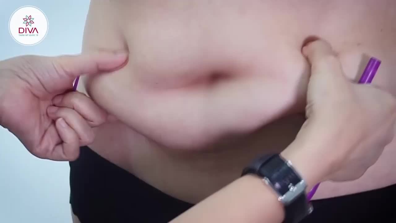 EO GỌN, DÁNG THON NGAY SAU HÚT MỠ