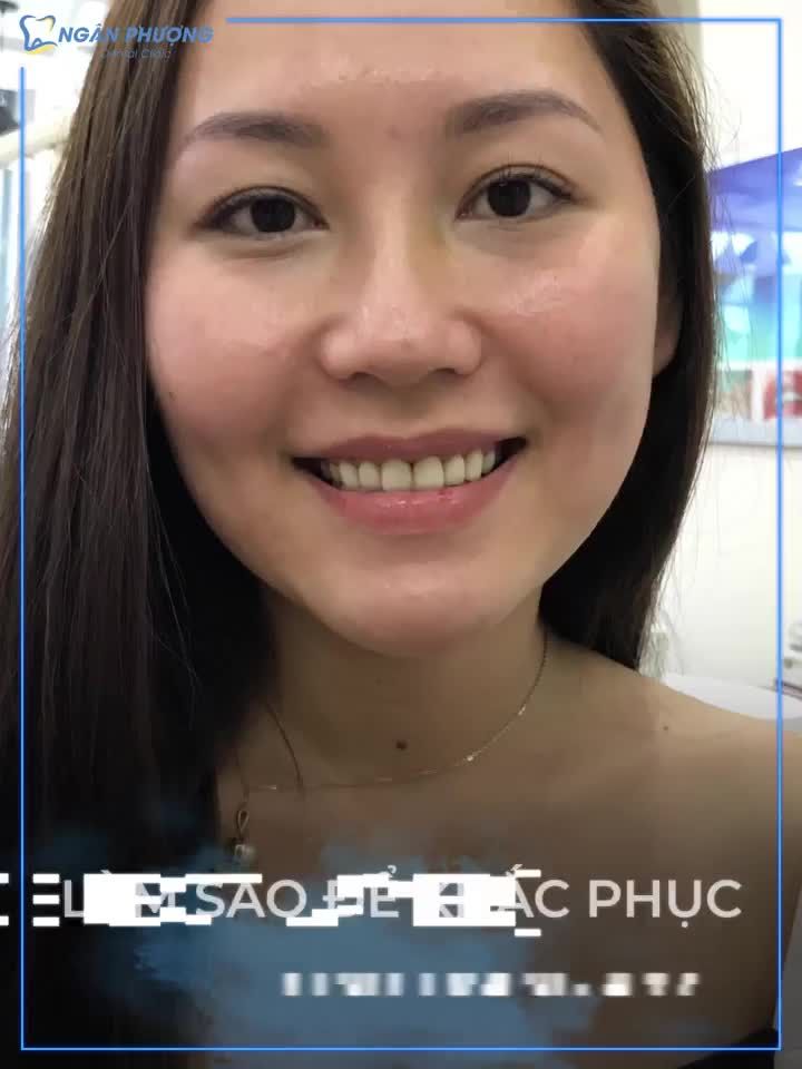 GIẢM NGAY 40% CHO KHÁCH HÀNG BỌC RĂNG SỨ TRONG THÁNG 10 TẠI CƠ SỞ 3: 67 HUỲNH VĂN BÁNH