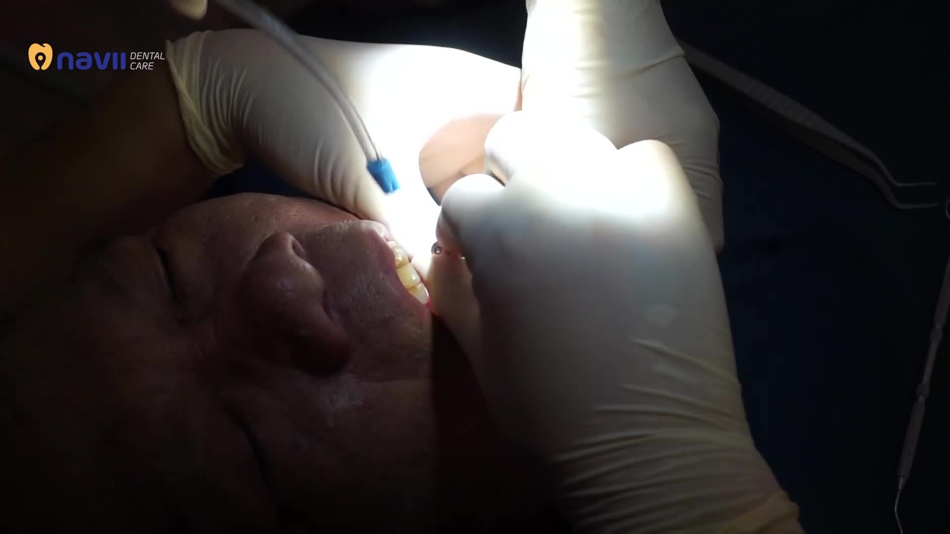 LẮP HÀM IMPLANT ALL-ON-6 TẠI NAVII DENTAL CARE