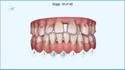 MÔ PHỎNG QUÁ TRÌNH NIỀNG RĂNG HÔ, THƯA BẰNG PHƯƠNG PHÁP NIỀNG RĂNG INVISALIGN