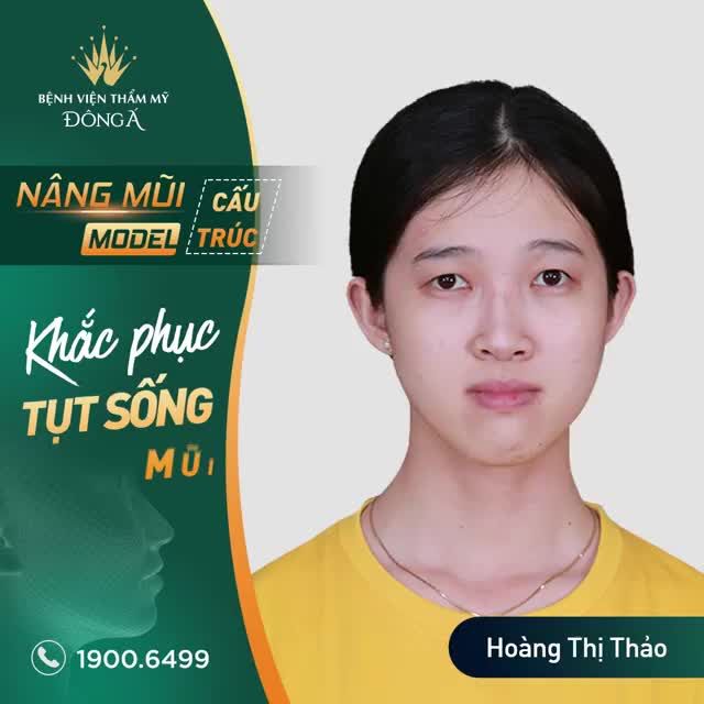 Mũi thấp, gồ, bè, hếch, phức tạp, dị dạng Mũi Xấu kiểu nào - Nâng đẹp kiểu đó!