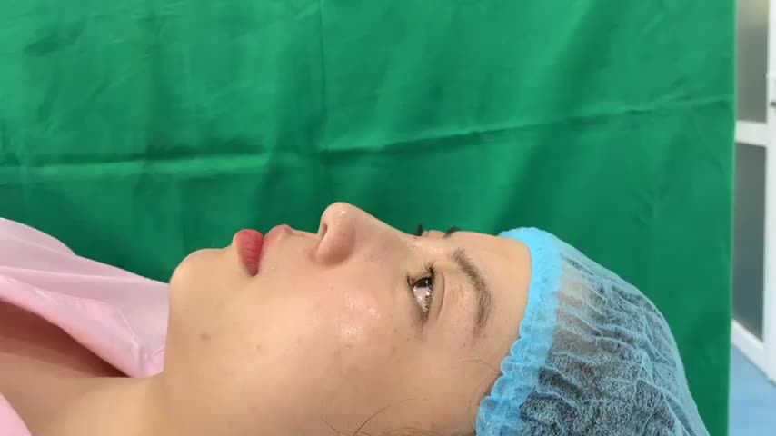 NGẮM NHÌN DÁNG MŨI MESHAPE CỦA BẠN NGA NGAY SAU PHẪU THUẬT