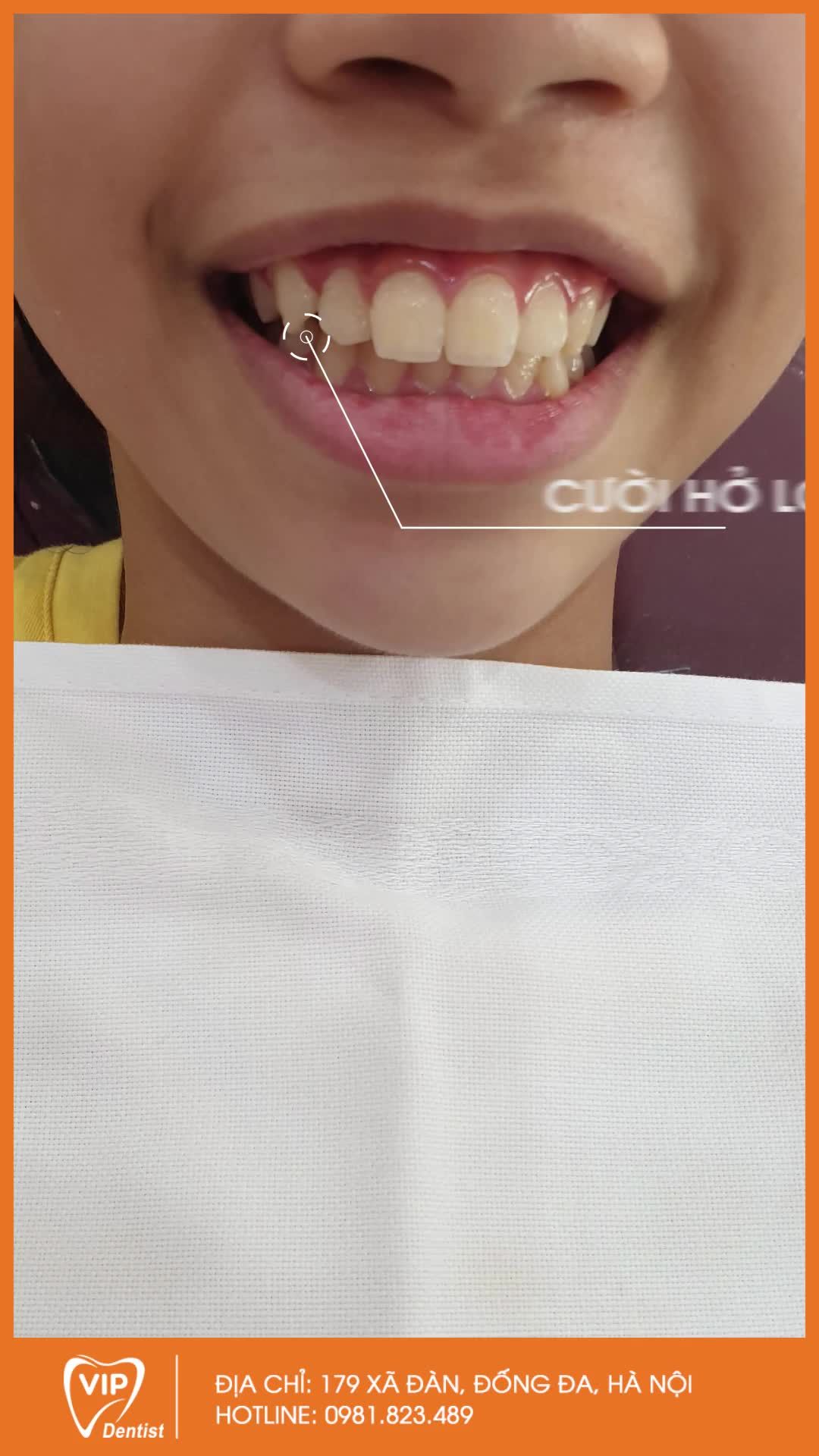 QUY TRÌNH NIỀNG RĂNG MẮC CÀI KIM LOẠI