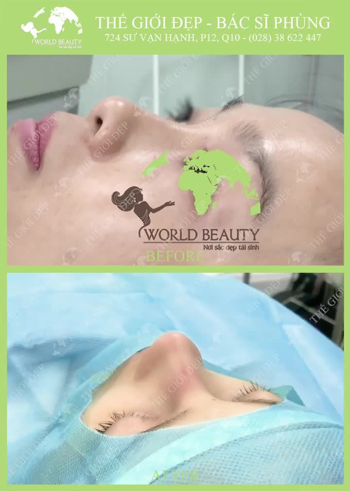 Tại sao sụn SURGIFORM được ưa chuộng trong PT N.ÂNG MŨI