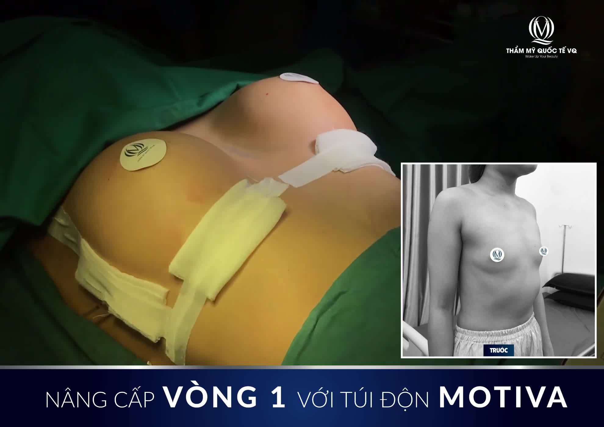 Thoát khỏi "Màn hình siêu phẳng" nhờ NÂNG CẤP VÒNG 1 với túi MOTIVA