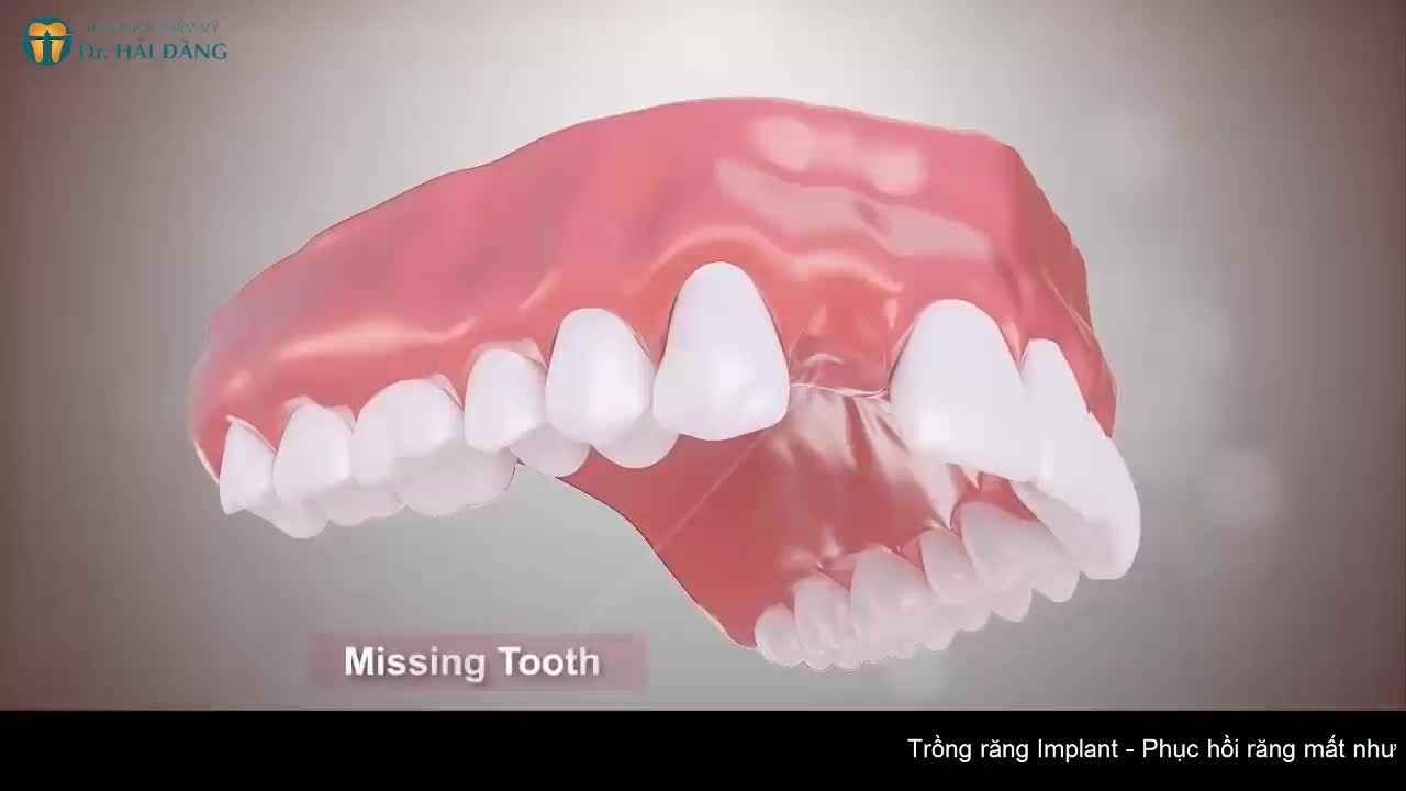 TRỒNG RĂNG IMPLANT TẠI VIỆT NAM GIẢI PHÁP SỐ 1 CHO NGƯỜI MẤT RĂNG