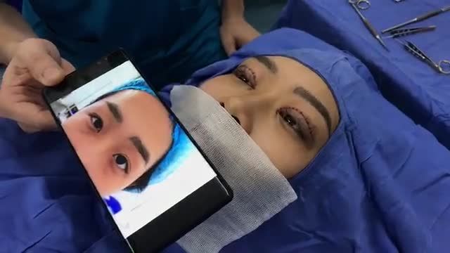 Ca cắt mí Baby Eyes 6D siêu đẹp cho bạn gái đến từ Hà Nội !