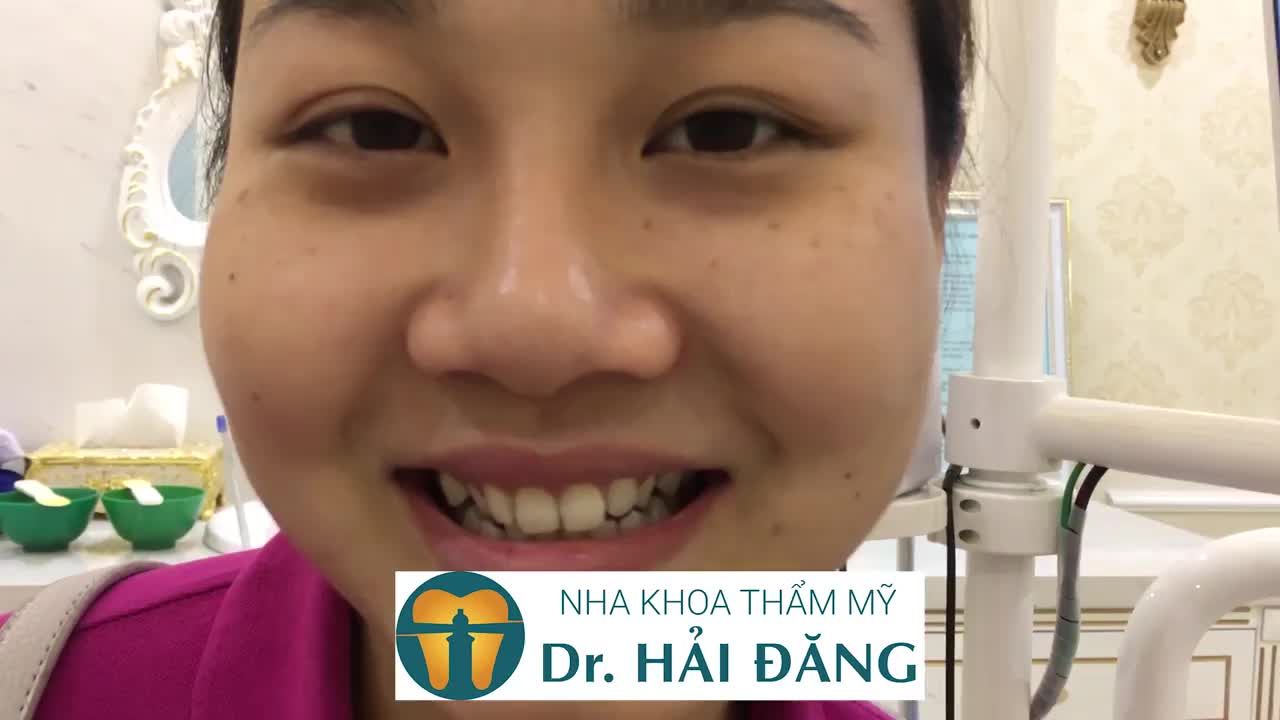 CÔNG NGHỆ BỌC SỨ KỸ THUẬT CAO tại Nha khoa thẩm mỹ Dr Hải Đăng