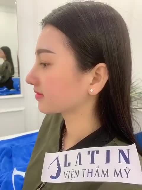 Hóa hot girl sau nâng mũi cấu trúc lót megaderm và mài xương.