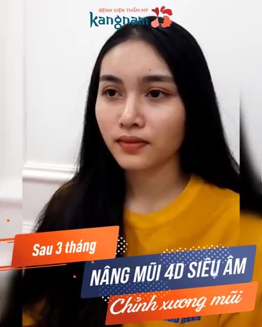 90 Phút Xóa dấu vết MŨI TO BÈ, gương mặt trở nên thanh tú với MŨI CAO - THON GỌN
