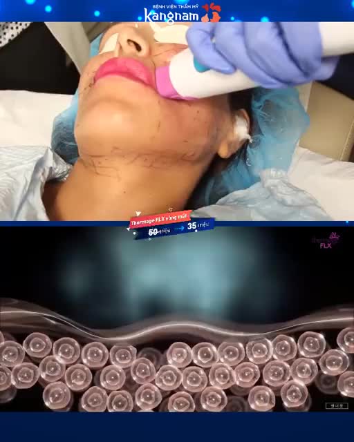 Nếp nhăn, chân chim, chảy xệ do tuổi tác - Cải thiện 90% sau khi làm THERMAGE FLX