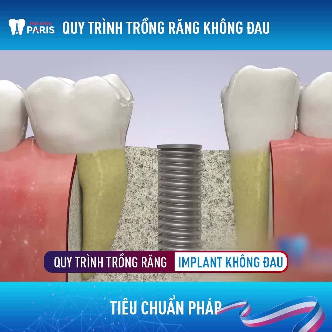 CẬN CẢNH QUY TRÌNH THAY THẾ RĂNG MẤT VỚI CÔNG NGHỆ 4.0