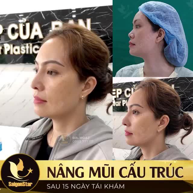 NÂNG MŨI CẤU TRÚC SAU 15 NGÀY TÁI KHÁM