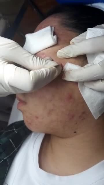 NẶN MỤN QUÁ ĐÃ - DA SẠCH HỒI SINH