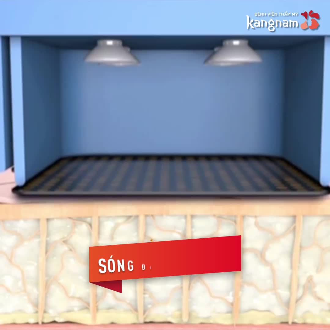 Trẻ hóa da, xóa nếp nhăn KHÔNG PHẪU THUẬT - Thermage FLX
