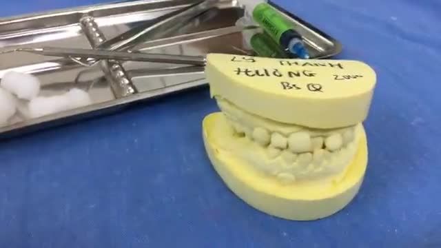 gắn mắc cài tại Nha Khoa Thuỳ Anh cho bạn Hương