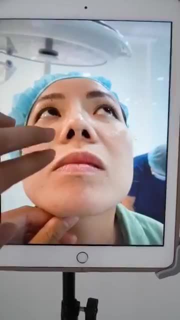 MŨI CẤU TRÚC SỬA LẠI SAU 8 NGÀY KHÁCH ĐẾN TÁI KHAM