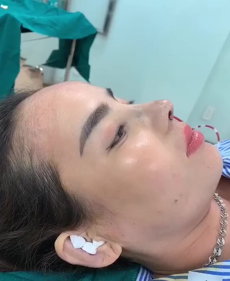 Mũi sửa lại cho KH đến từ Bình Phước