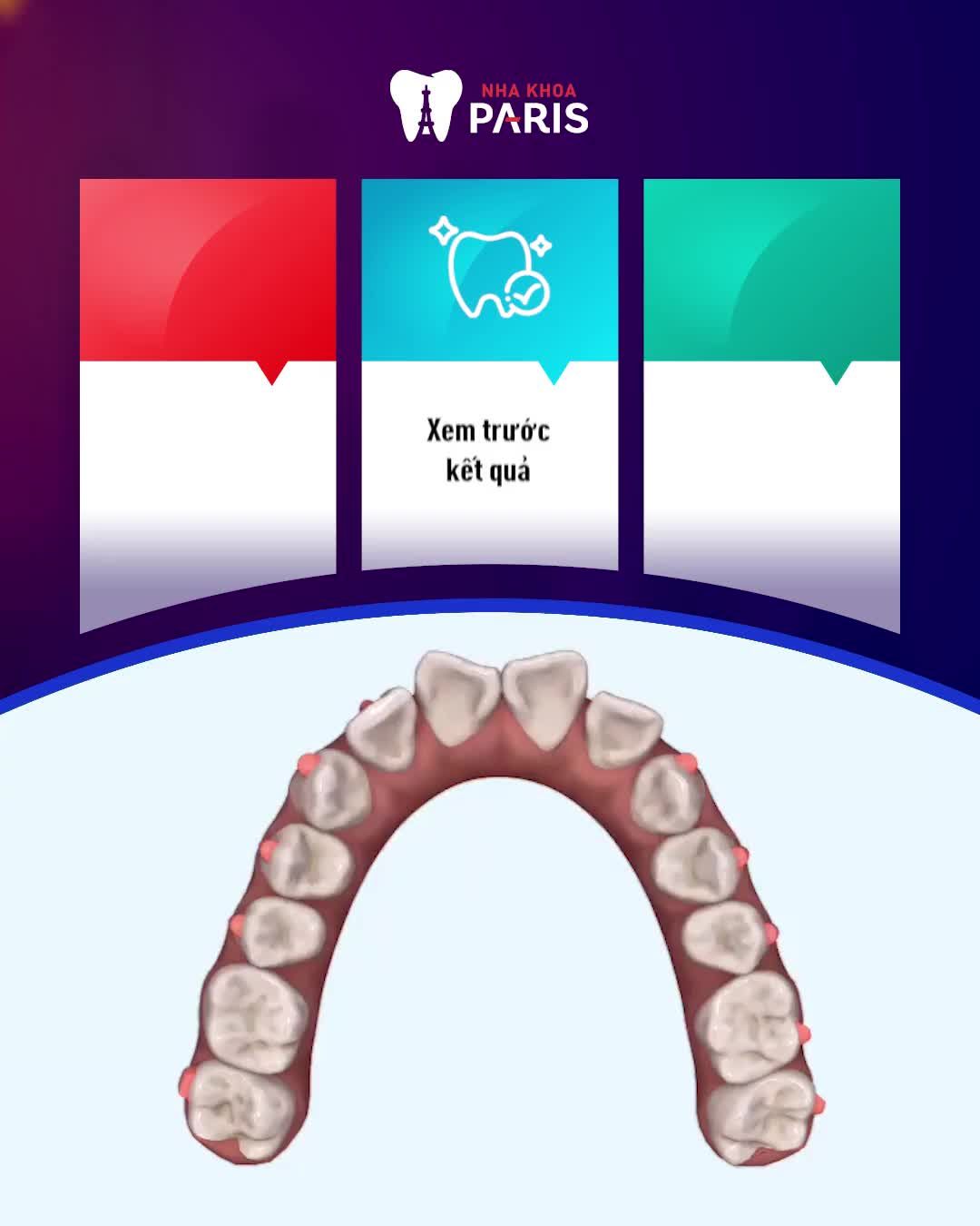 RĂNG ĐỀU ĐẸP KHÁC BIỆT SAU 2 THÁNG