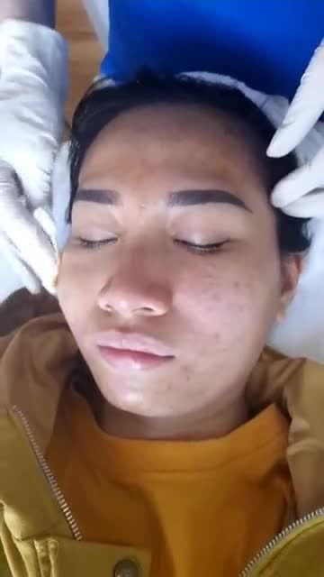 QUÁ TRÌNH CHIẾU ÁNH SÁNG TRONG TRỊ MỤN NANO SKIN