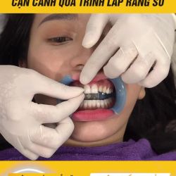 DÁN SỨ VENEER TIÊU CHUẨN ĐỨC - KHÔNG MÀI RĂNG