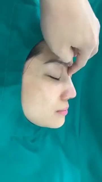 Nâng mũi cao tự nhiên