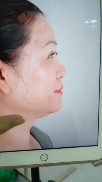 SỬA LẠI CA MŨI BỊ HỎNG CHO KHÁCH SAU KHI NÂNG NƠI KHÔNG UY TÍN DẪN ĐẾN LỘ SÓNG, BÓNG ĐỎ ĐẦU MŨI