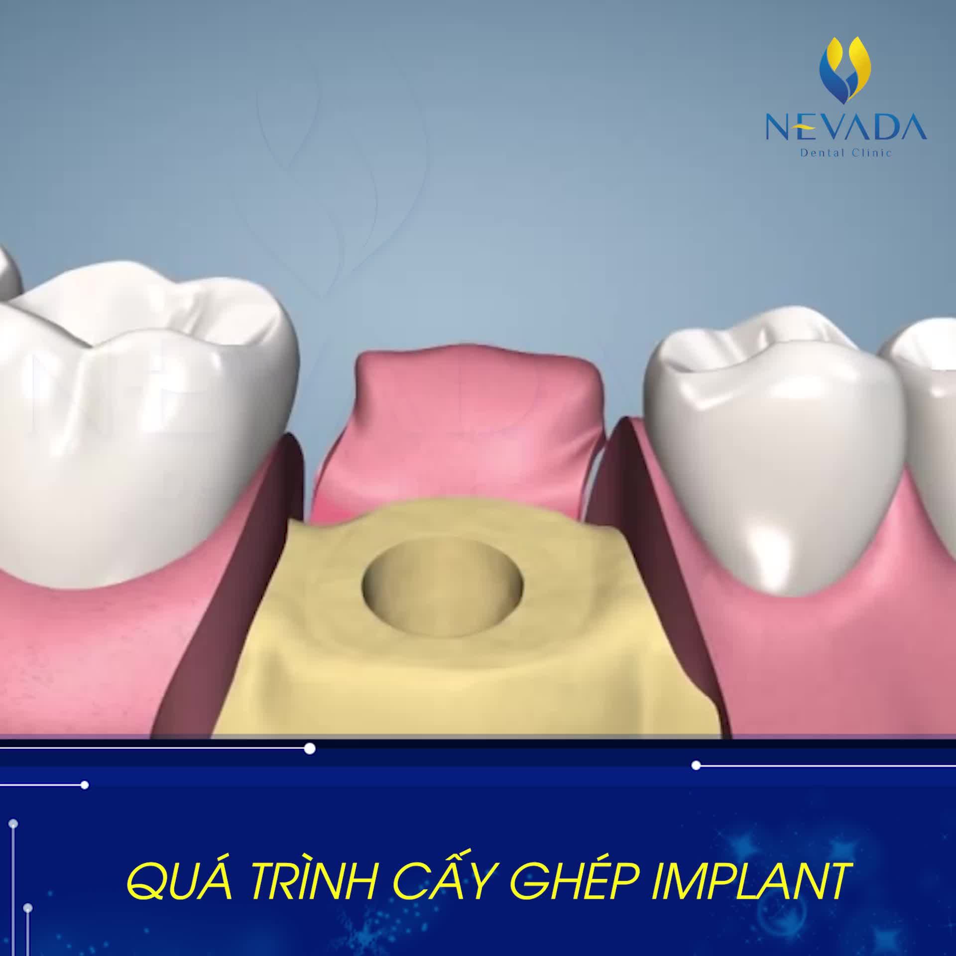 Trồng răng Implant được xem là giải pháp tiên tiến nhất hiện nay trong phục hình răng đã mất.