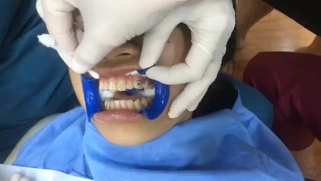 Gắn mắc cái niềng răng điều trị khớp cắn ngược cho bạn Mai đến từ Bắc Kạn