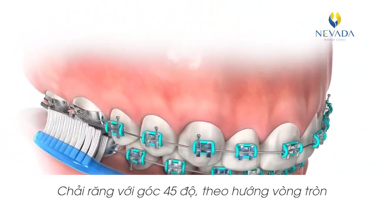 Niềng răng Chỉnh nha là giải pháp nắn chỉnh răng được người Việt nói chung và giới trẻ nói riêng cực kỳ ưa chuộng
