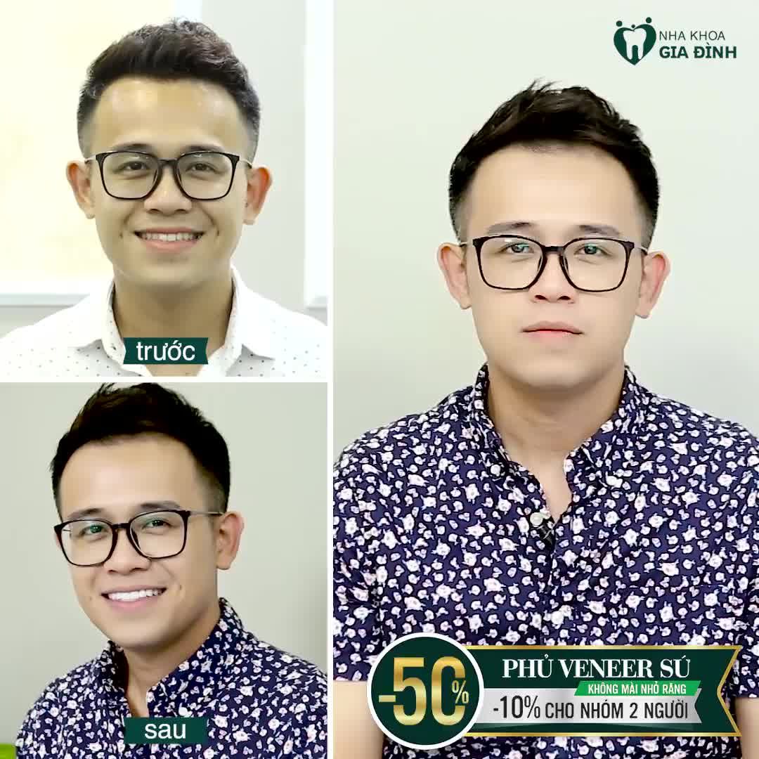 DÁN SỨ VENEER - Bảo tồn răng thật - Không xâm lấn