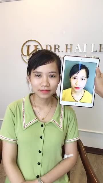 kết quả cắt mí vừa thực hiện xong của em gái đến từ Hải Dương