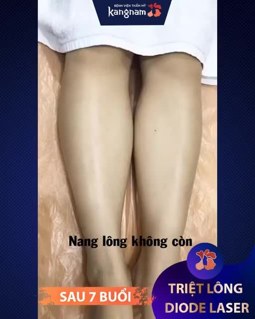 Lấy lại tự tin với đôi chân láng mịn SẠCH LÔNG chỉ sau 7 buổi