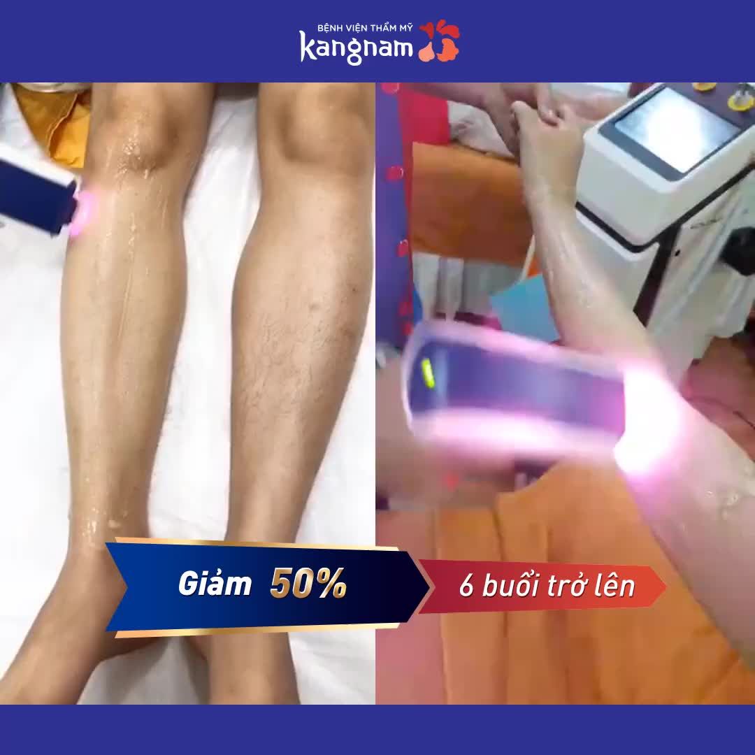 Lông tay, lông chân, lông nách... trị sạch bách sau 3 buổi tới Kangnam