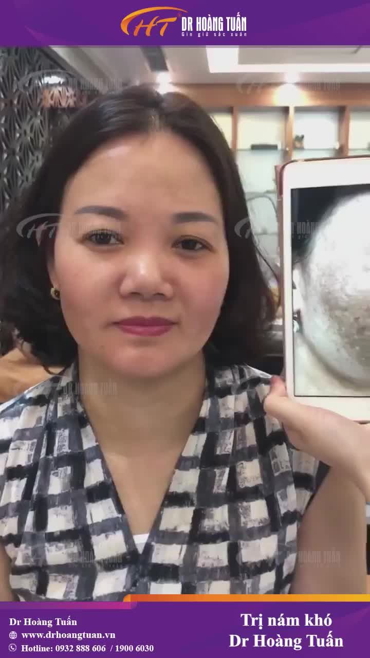 Nám không khó để trị - Quan trọng phải lựa chọn đúng phương pháp và địa chỉ uy tín