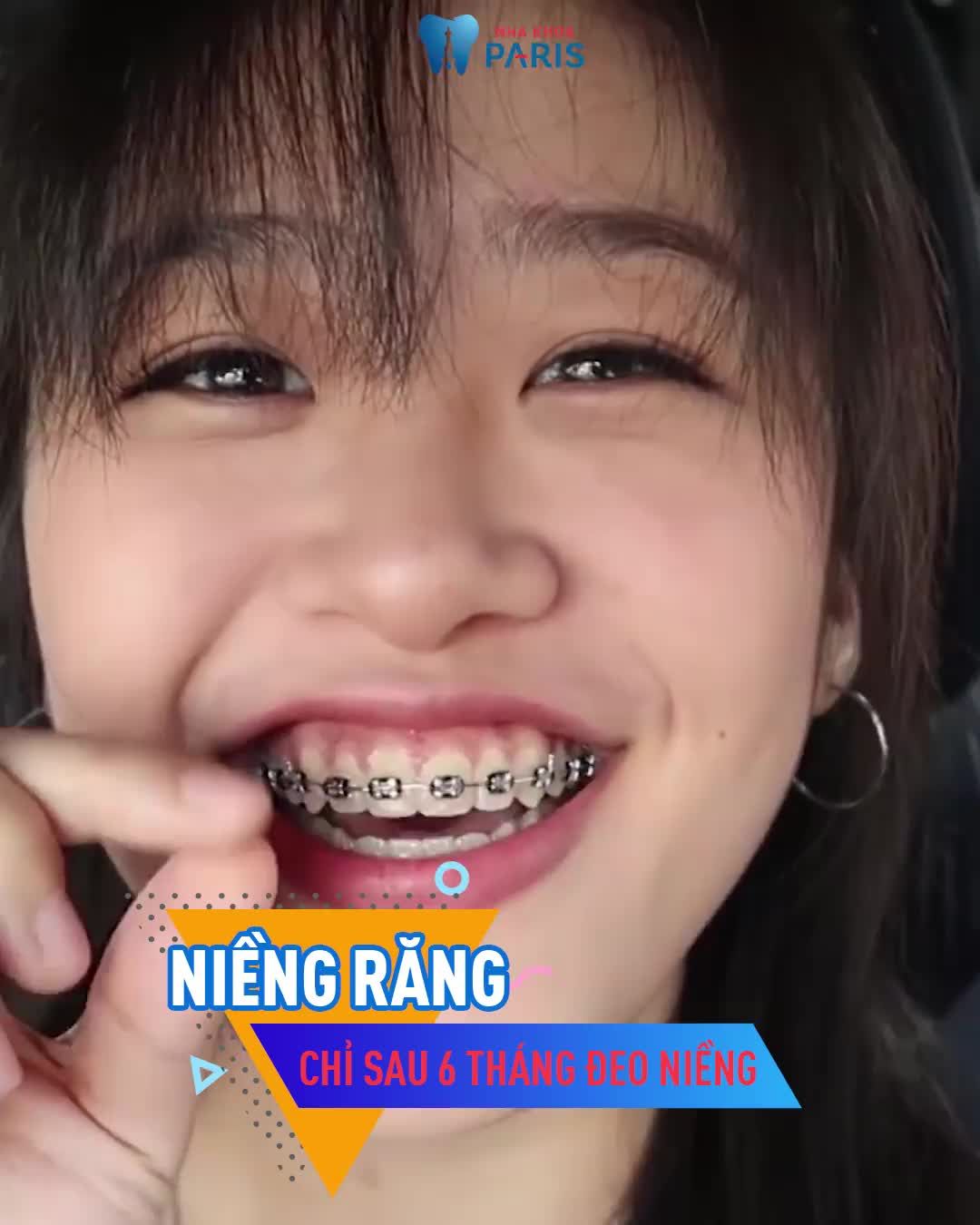 RĂNG XẤU XÍ HÔ – THƯA – MÓM – KHẤP KHỂNH  ĐỪNG LO