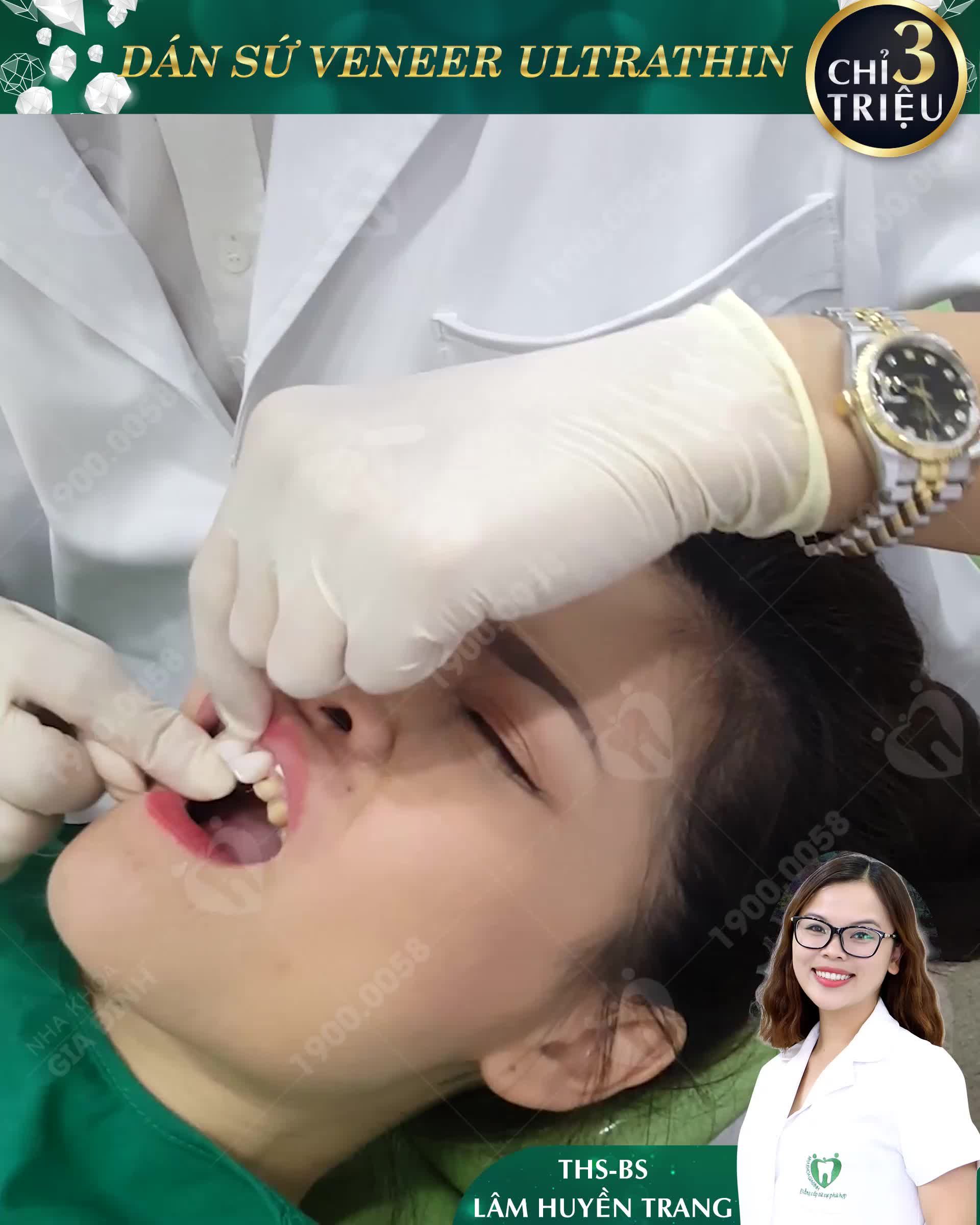DÁN SỨ VENEER: ĐẸP – TỰ TIN – CUỐN HÚT